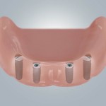 Zahnloser UK mit Implantaten